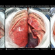 Imagen para el artículo titulado Logran reparar pulmones humanos dañados al conectarlos a cerdos vivos